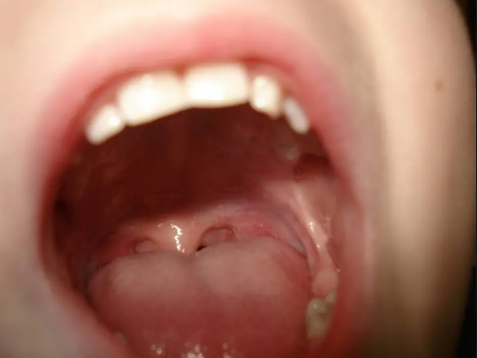 Câncer de boca: quais os sintomas e como prevenir