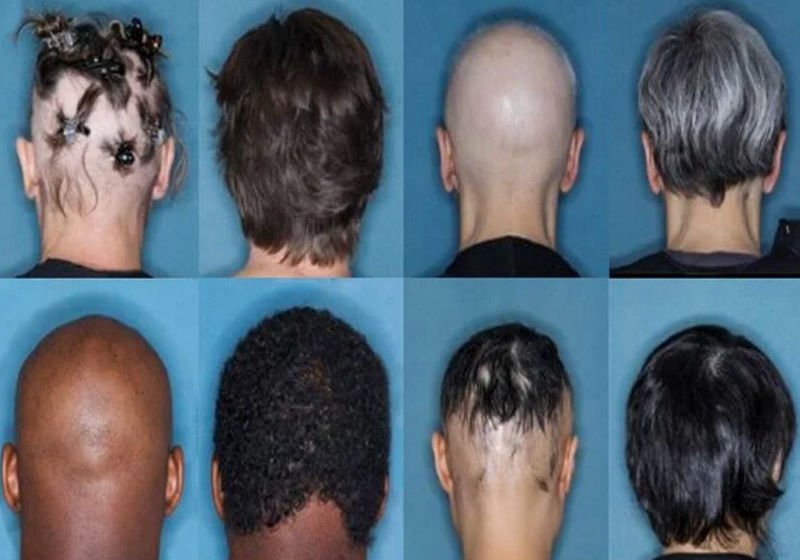 FDA aprova 1º remédio para alopecia que restaura cabelos em vários pacientes
