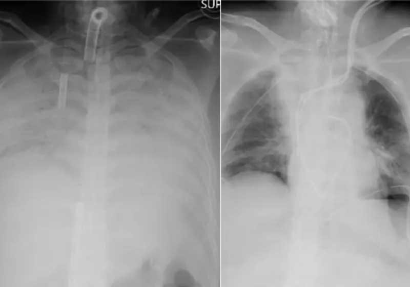 Japão faz 1º transplante de pulmão de doador vivo em paciente