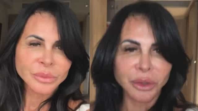 Gretchen exibe resultado de cirurgia plástica: "Sem filtro"