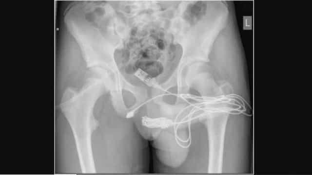 Jovem de 15 anos passa por cirurgia após tentar medir pênis com cabo USB