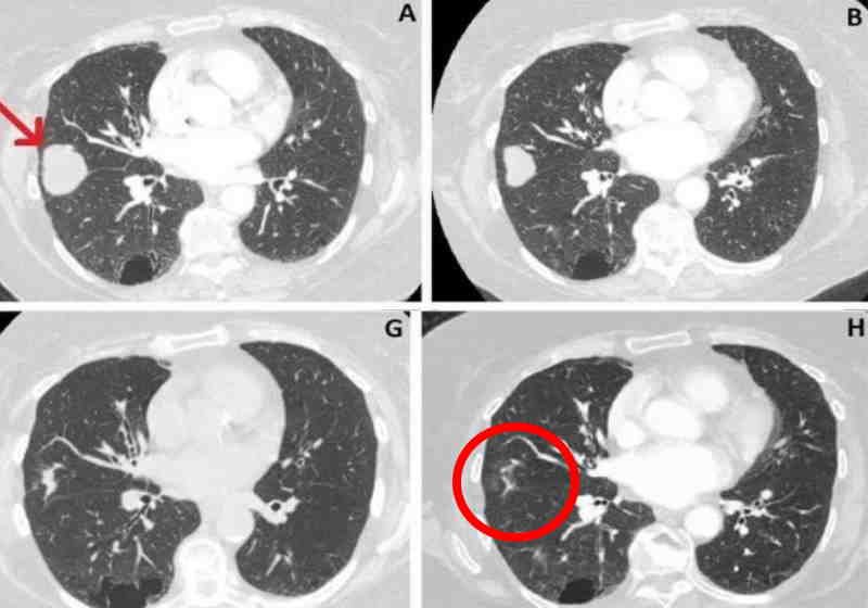 Tumor no pulmão de idosa reduz 76% após uso de canabidiol