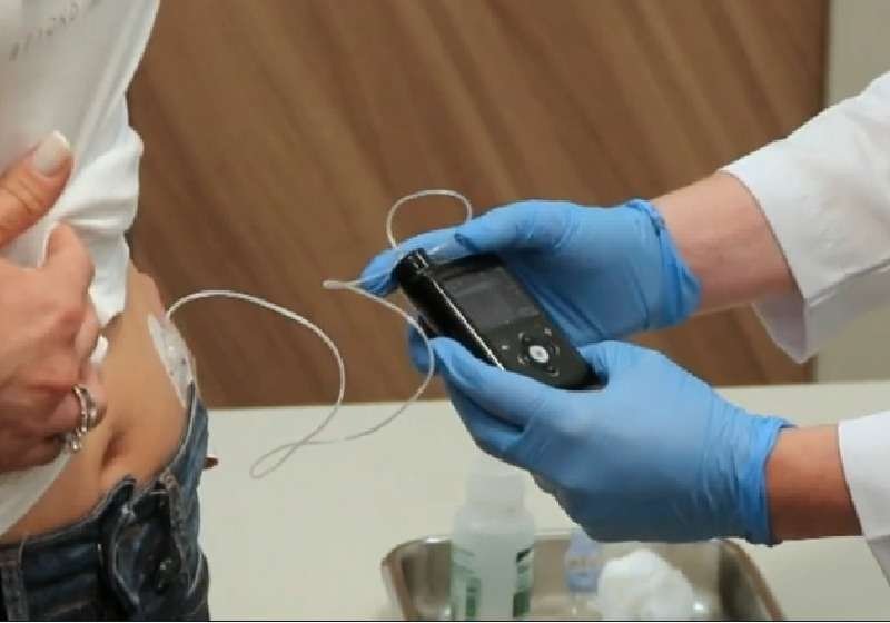 1º implante de pâncreas artificial é realizado no Brasil: diabetes