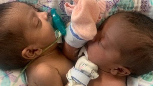 Gêmeas siamesas são separadas após operação que durou 11 horas nos EUA