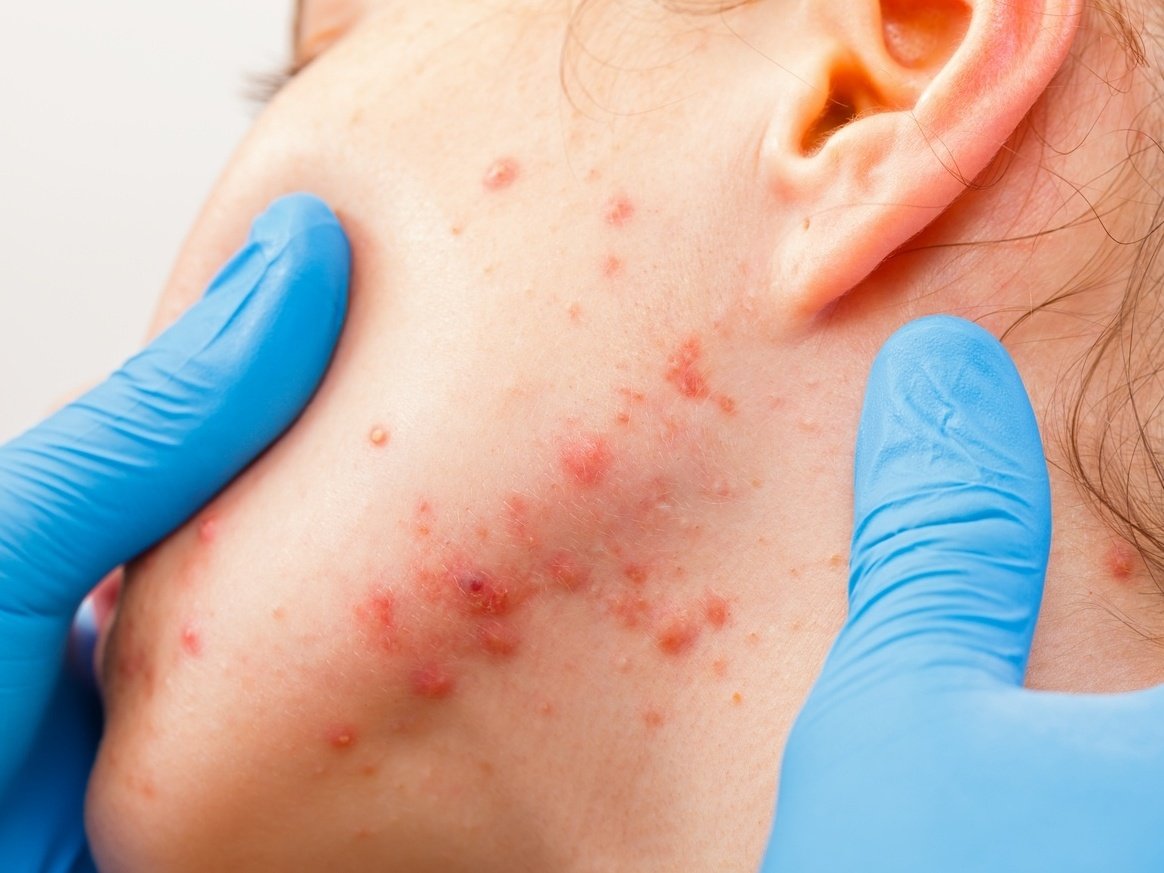 Controle de acnes na adolescência pode ser feito com alimentação saudável