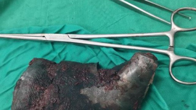 Médicos em Gaza removem estilhaço de um quilo de homem palestino
