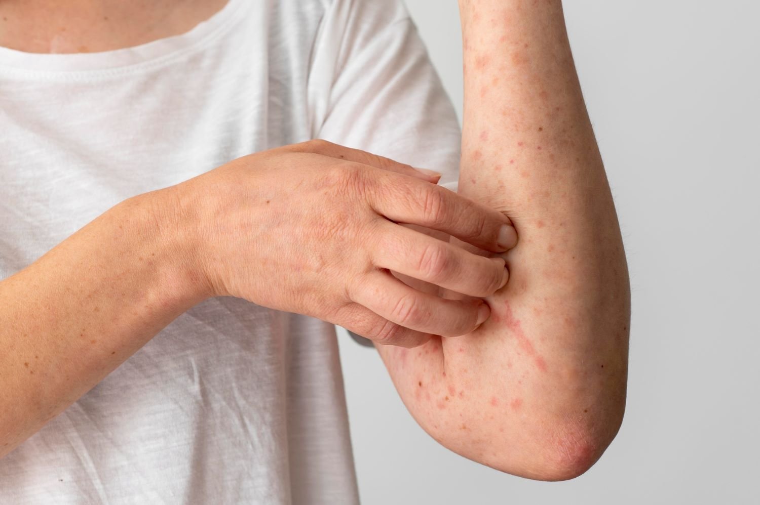 Manejo da dermatite atópica: entenda as inovações no cuidado da pele sensível