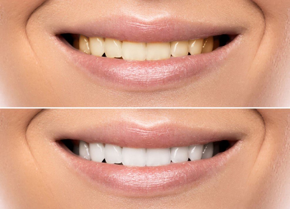 Clareamento dental caseiro sem supervisão profissional pode afetar a saúde bucal
